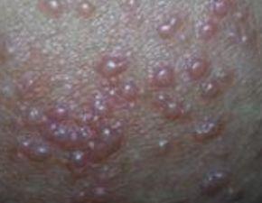 成人湿疹发病过程视频,成人湿疹症状与治疗全解析